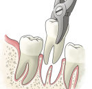 Удаление зубов. Хирургическое лечение