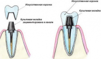 Протезирование зубов (ортопедия)